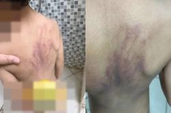 6岁自闭症患儿疑被托儿所虐待，父母控诉警方不作为